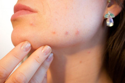 dùng cả tuổi thanh xuân để trị mụn